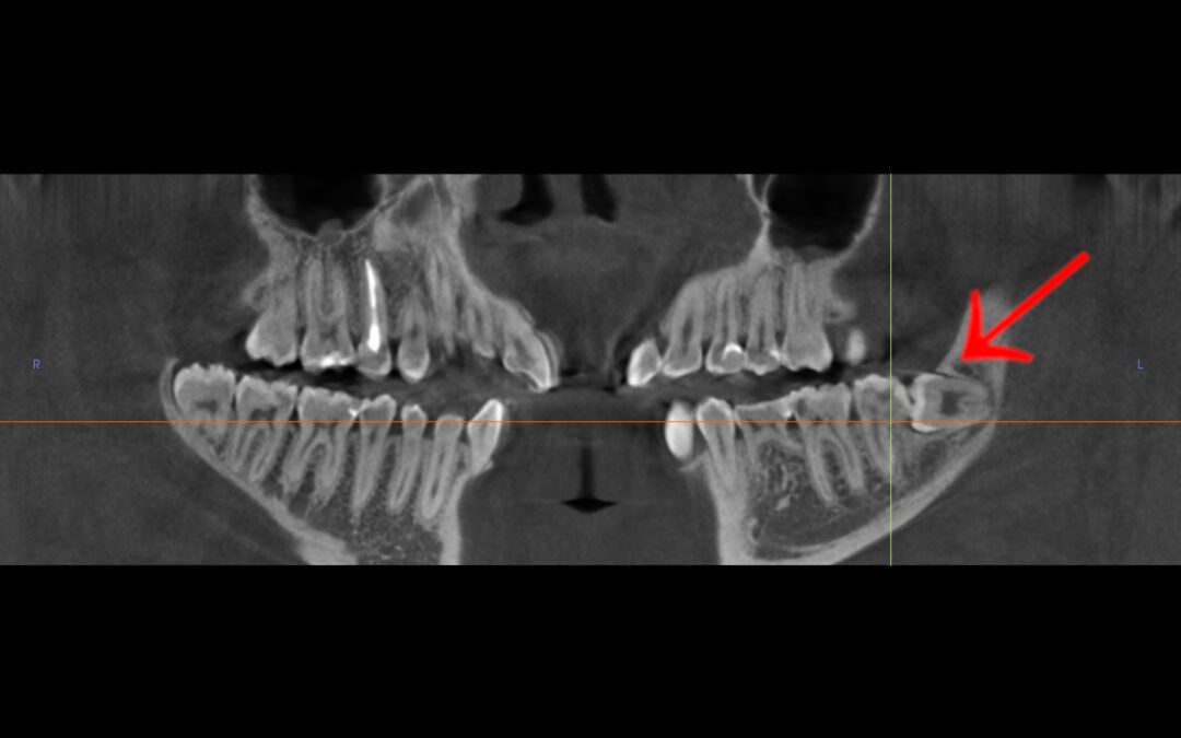 Usunięcie zatrzymanej ósemki — historia pani Igi