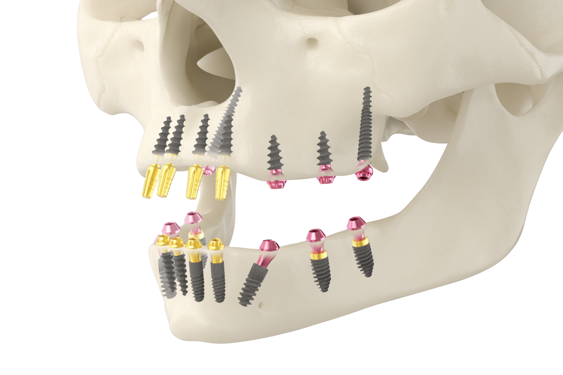 Implant zęba z koroną